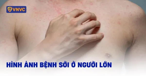 hình ảnh bệnh sởi ở người lớn